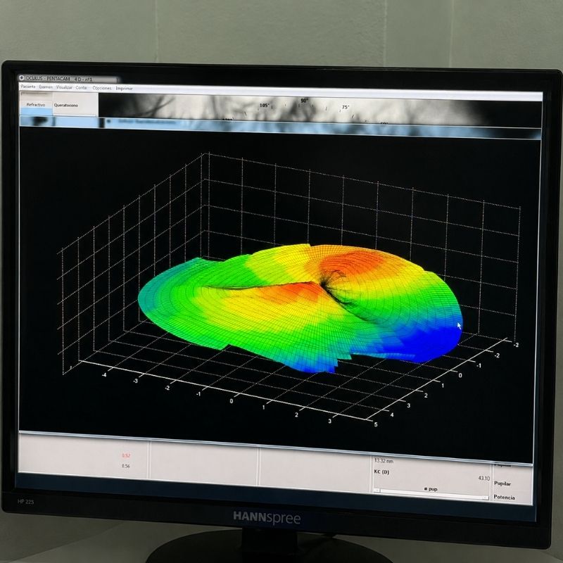 Contactología avanzada Lentes de contacto